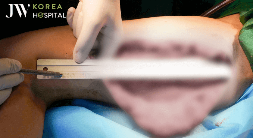Cô gái Việt hoại tử đùi sau tiêm filler toàn thân, mổ 60 lần để giữ mạng sống